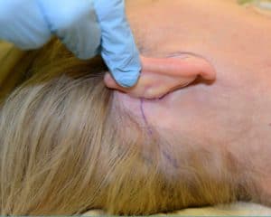 Facelift surgery edinburgh