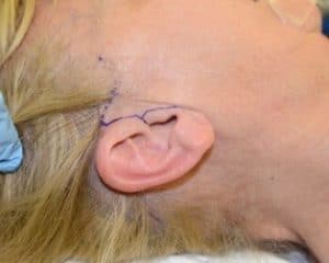Image demonstrating typical facelift markings in front of ear