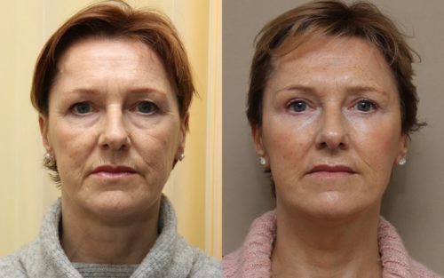 Facelift surgery Edinburgh