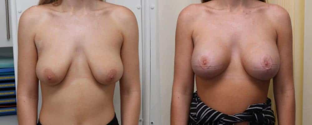 Breast lift with implants