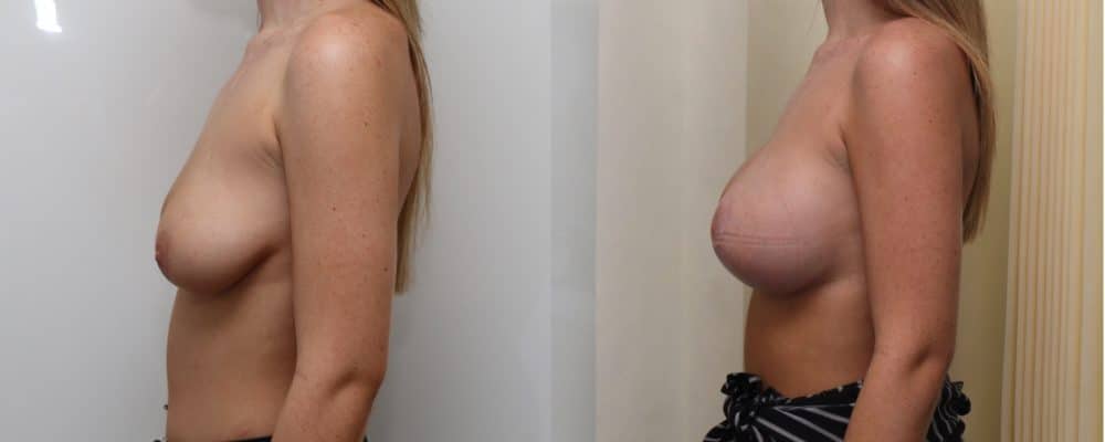 Breast lift with implants