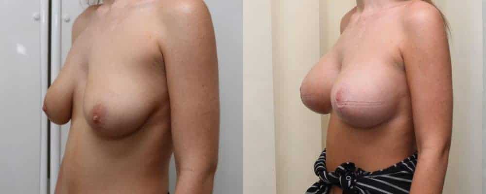 Breast lift combined with implants