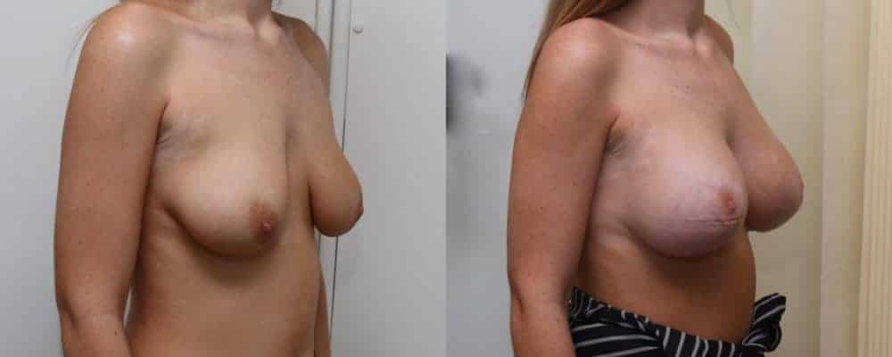 Breast lift combined with implants