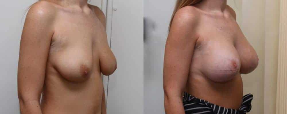 Breast lift with implants