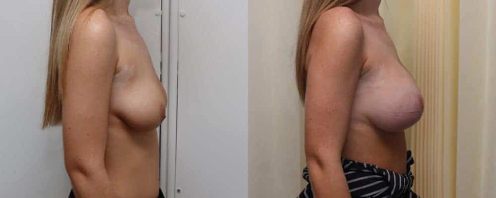 Breast lift with implants