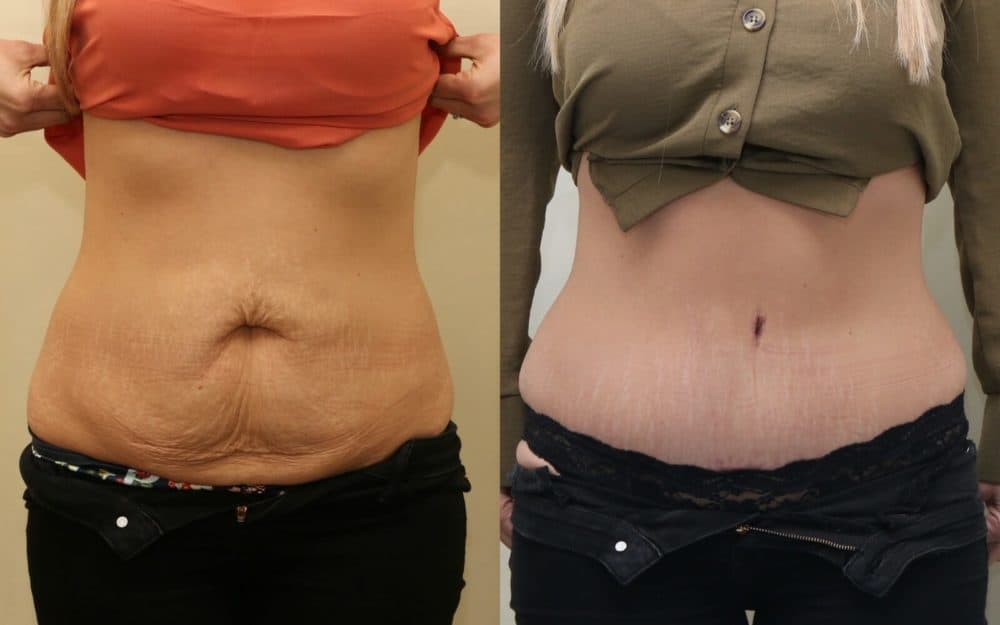 Abdominoplasty after previous pregnancies