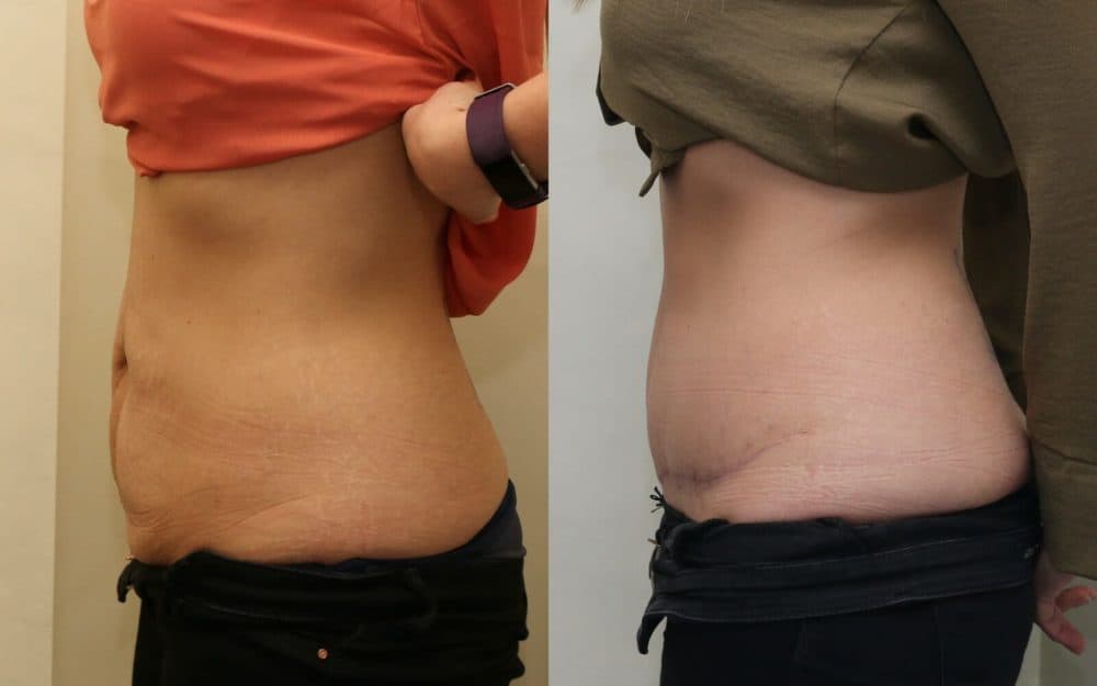 Abdominoplasty after previous pregnancies