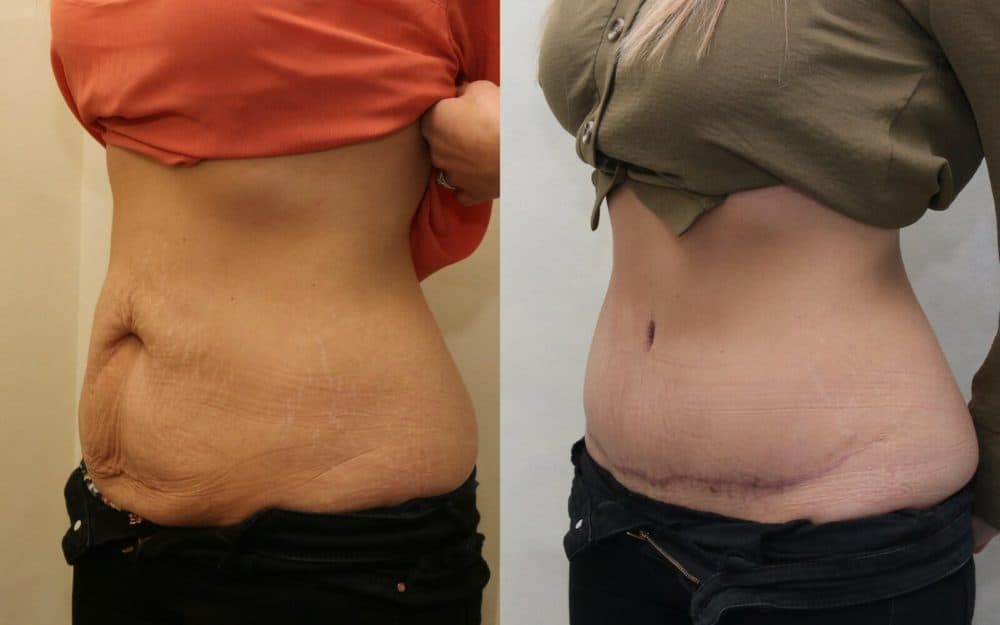 Abdominoplasty after previous pregnancies