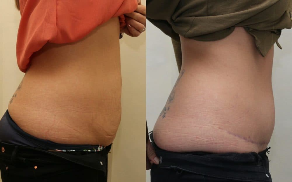 Abdominoplasty after previous pregnancies