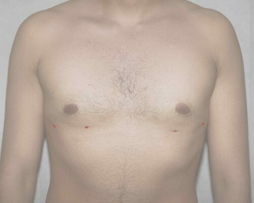 gyno surgery liposcution scar position