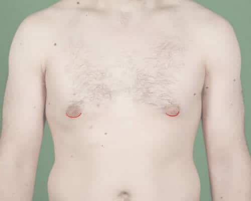 Moob surgery scotland scar position