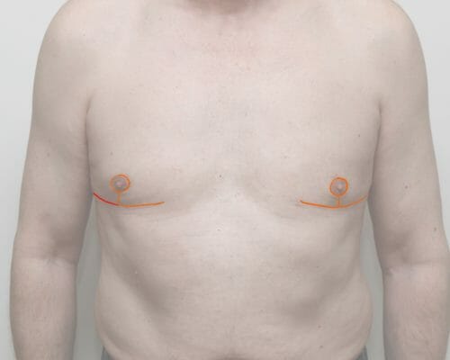 man boob scar position after skin excision Edinburgh