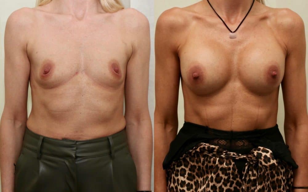 Dual plane round implant breast augmentation