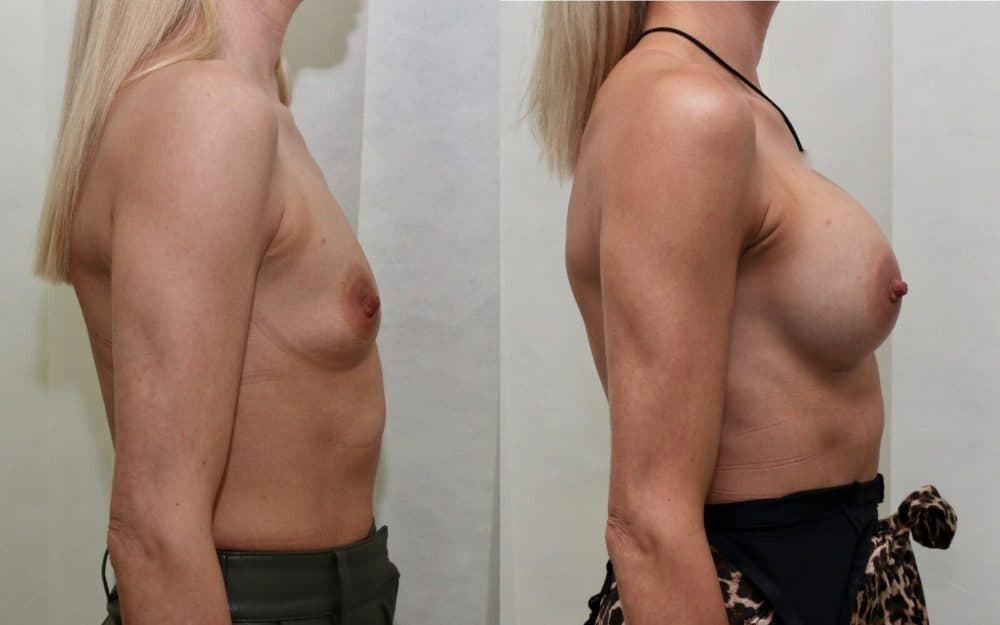 Dual plane round implant breast augmentation