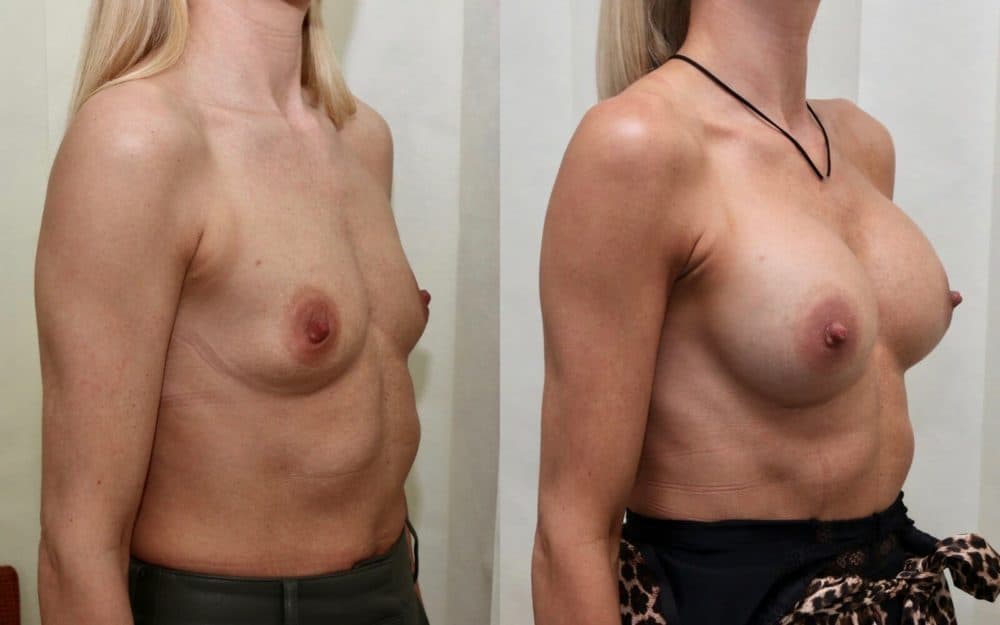 Dual plane round implant breast augmentation