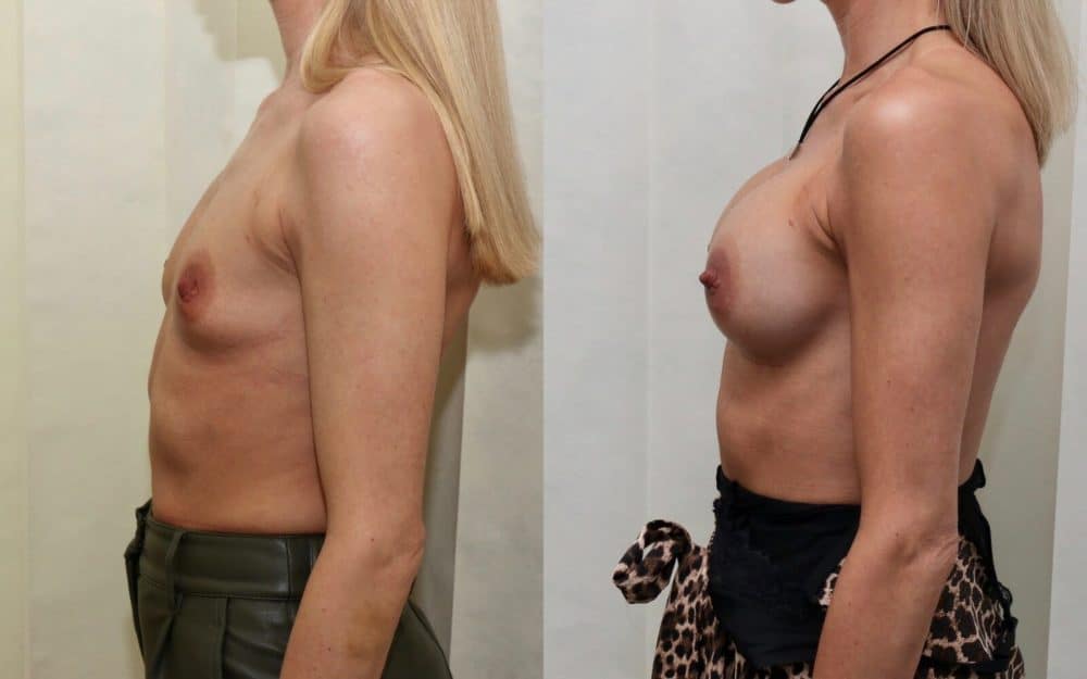 Dual plane round implant breast augmentation