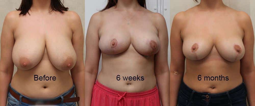 breast uplift edinburgh 