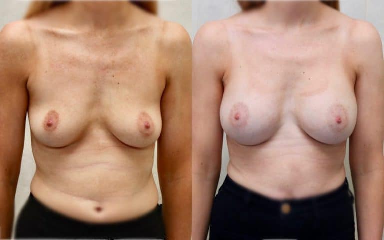 Breast augmentation before and after, case 22, photo 1 of 6