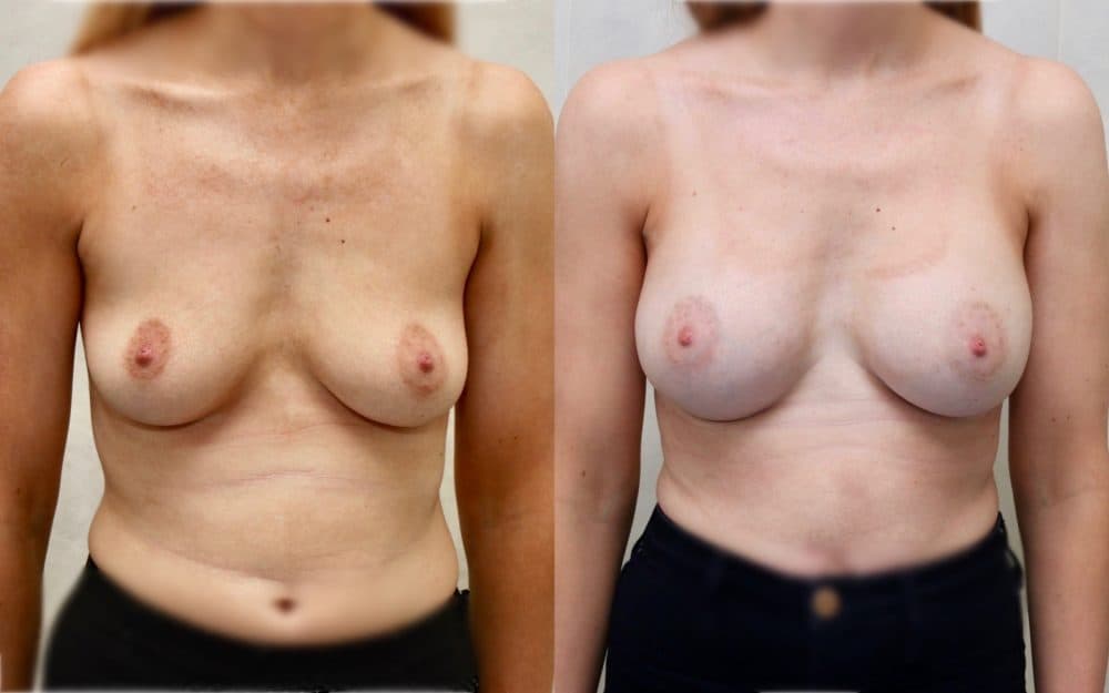 Under the muscle implants in a patient in her late 20s