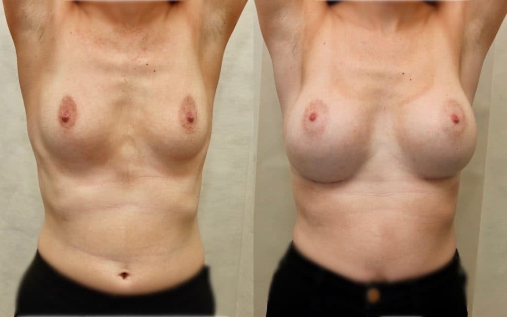 Under the muscle implants in a patient in her late 20s