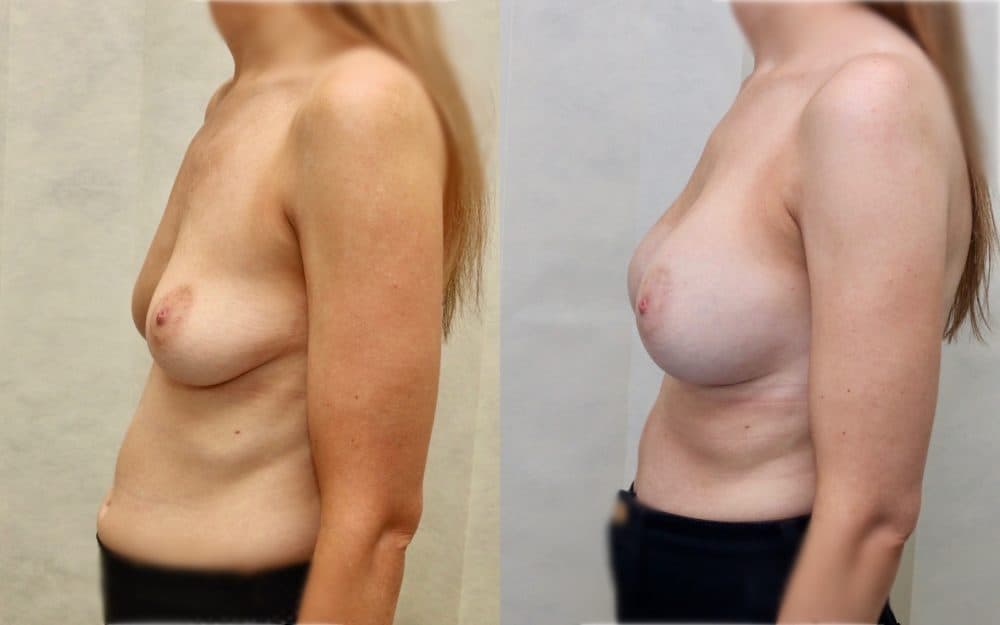 Under the muscle implants in a patient in her late 20s