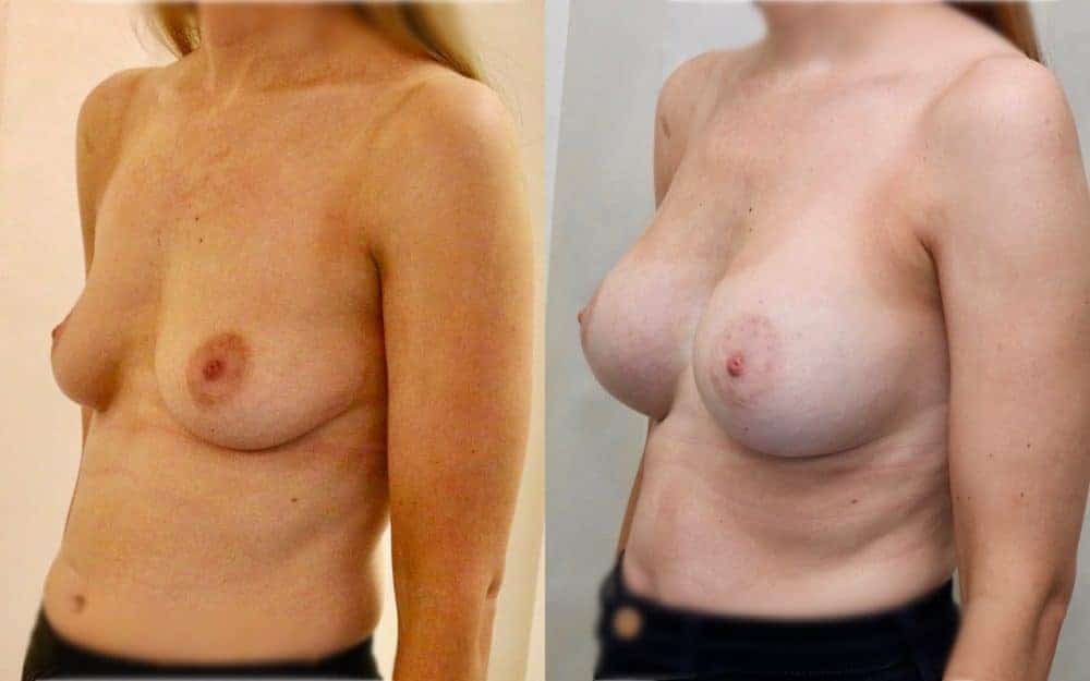 Under the muscle implants in a patient in her late 20s