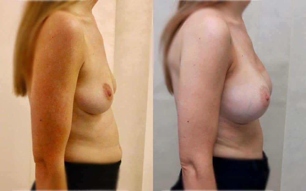 Under the muscle implants in a patient in her late 20s