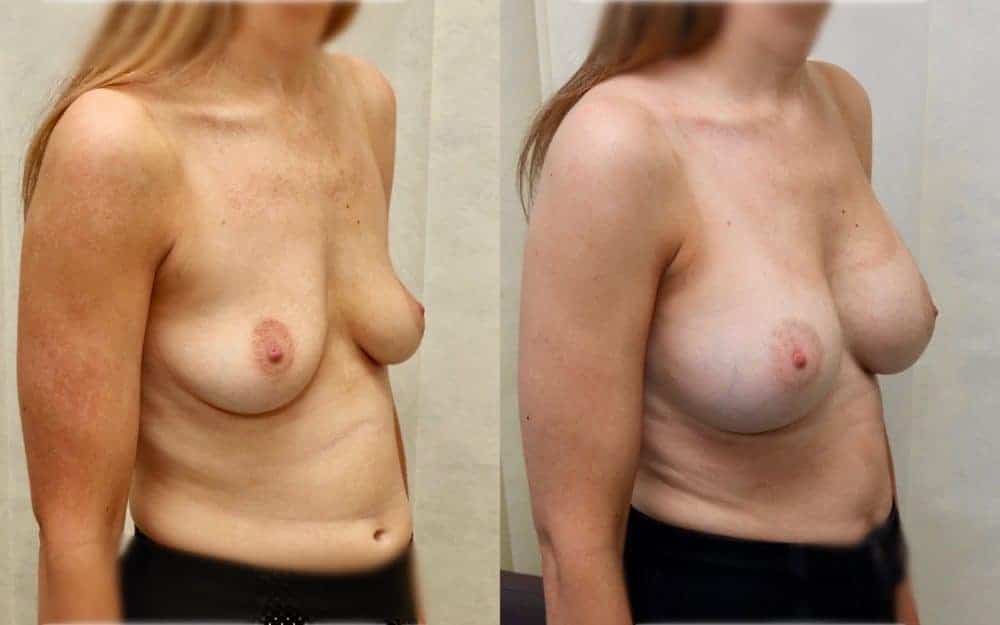 Under the muscle implants in a patient in her late 20s