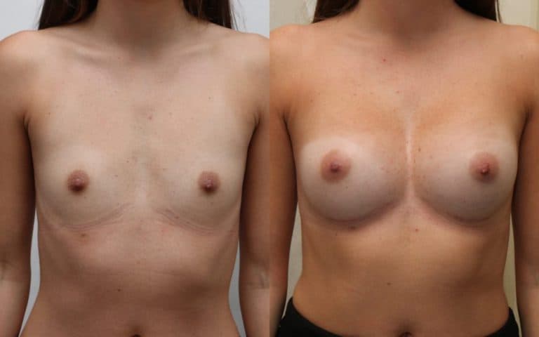 Small volume breast augmentation before and after, photo 1 of 6