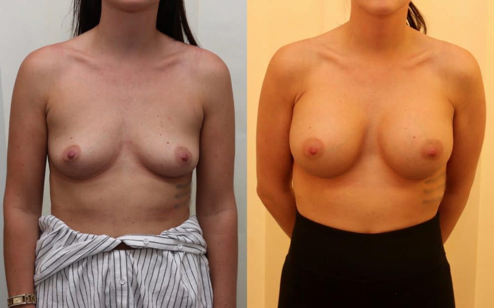 Large volume breast enlargement