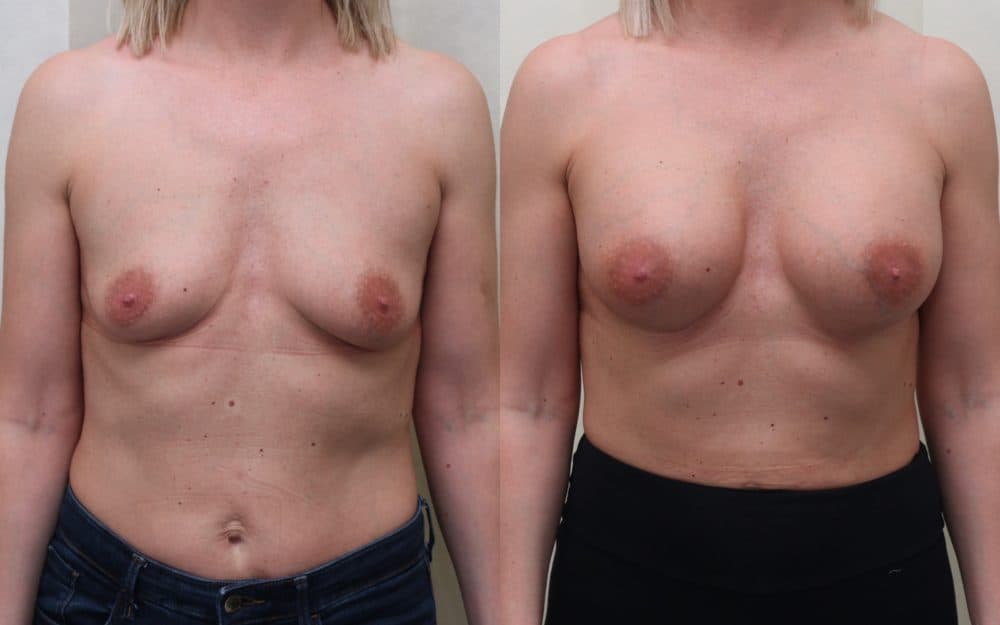 Dual plane breast implants