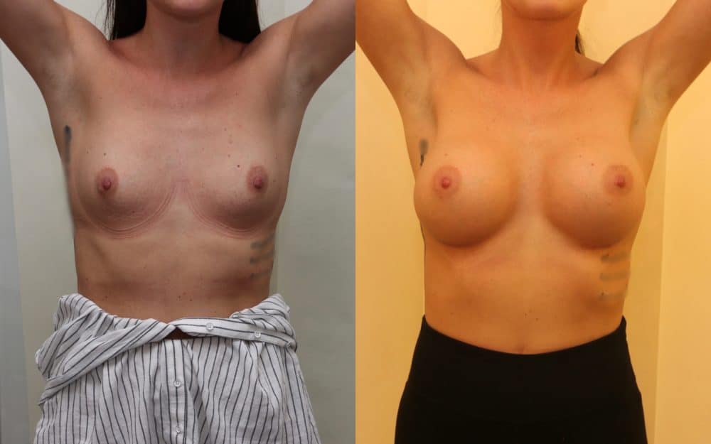 Large volume breast enlargement