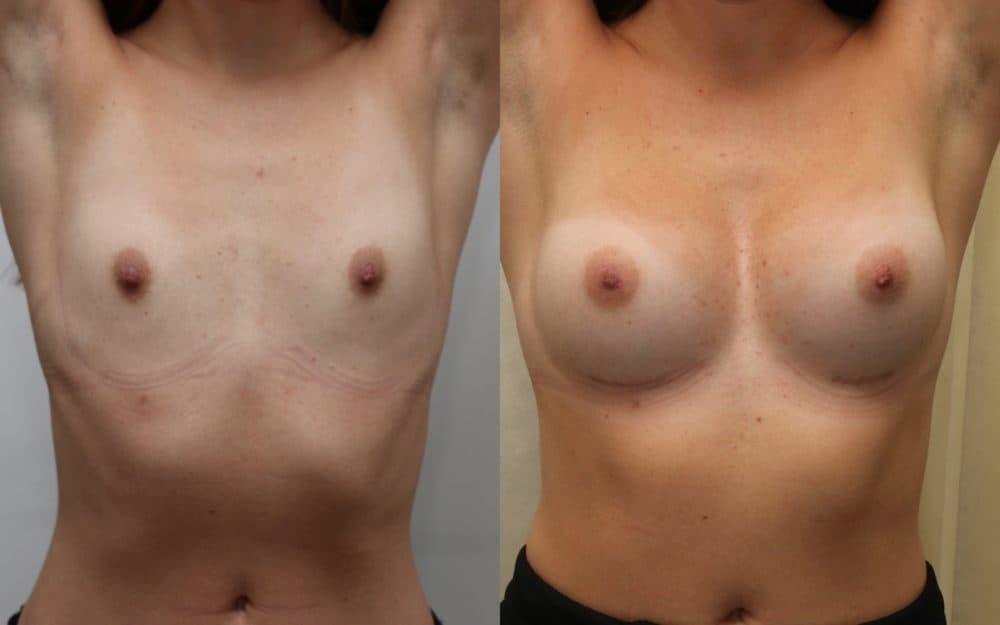 Small volume breast enlargement