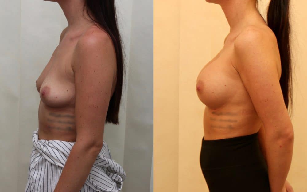 Large volume breast enlargement