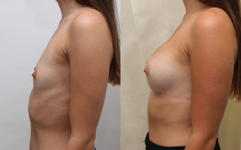 Small volume breast enlargement