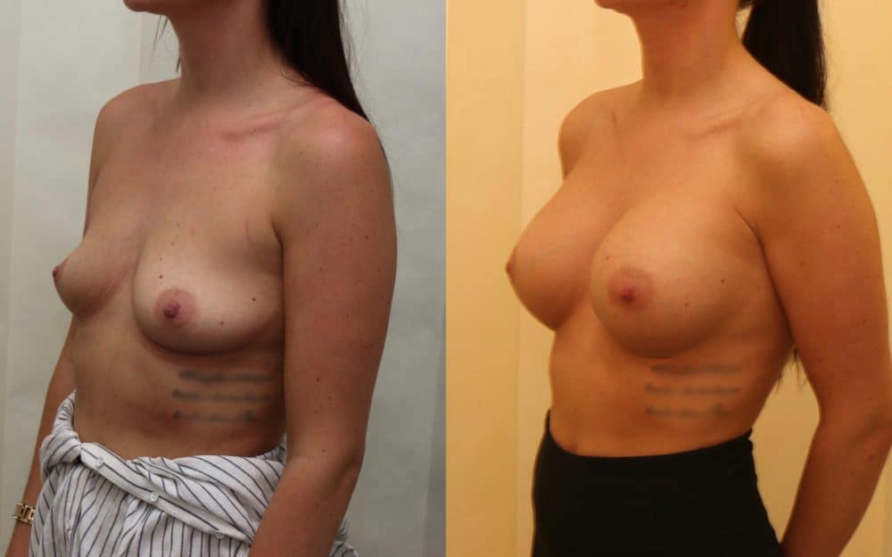 Large volume breast enlargement