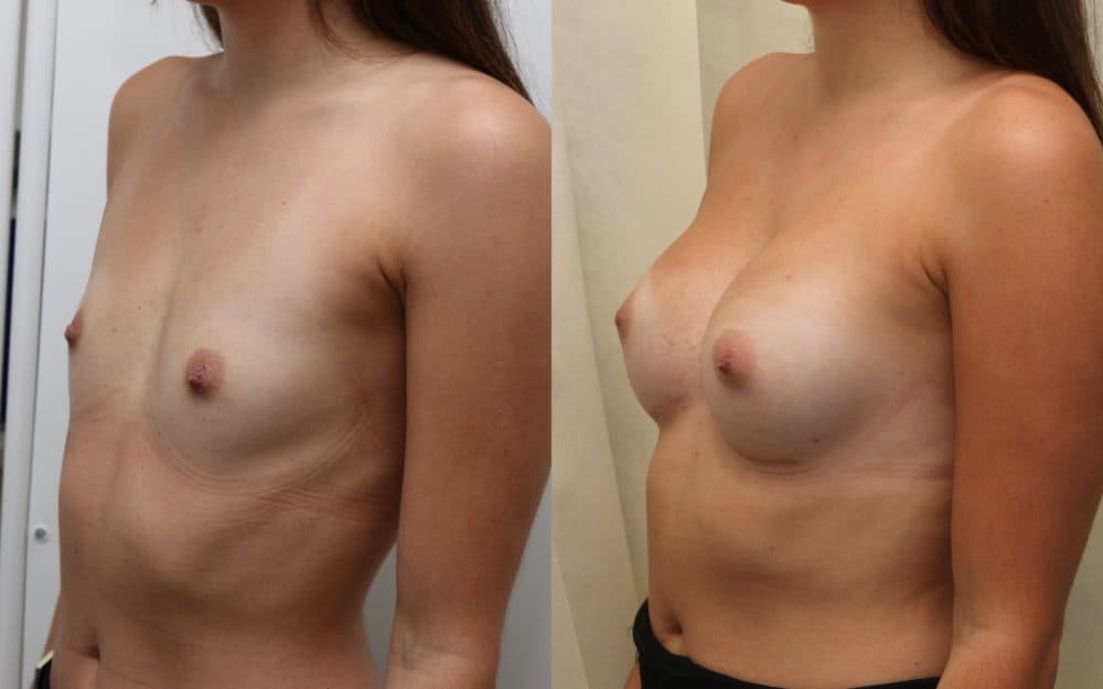 Small volume breast enlargement