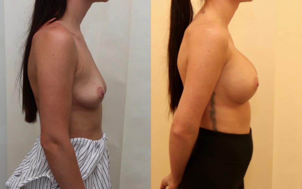 Large volume breast enlargement