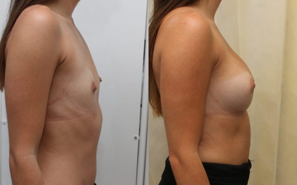 Small volume breast enlargement