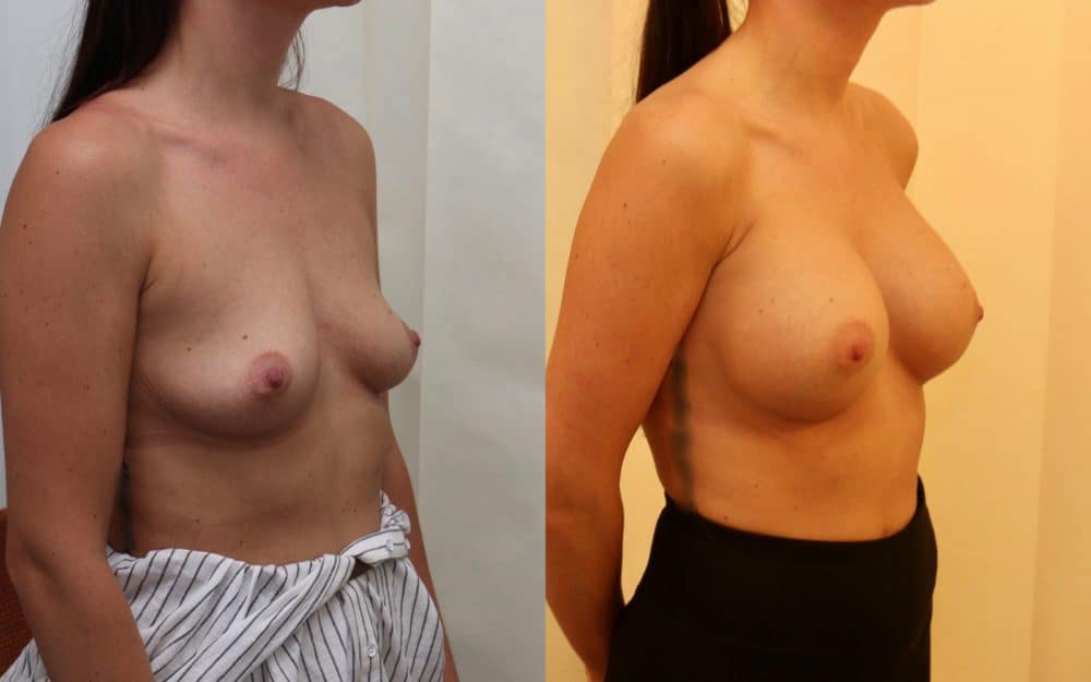 Large volume breast enlargement