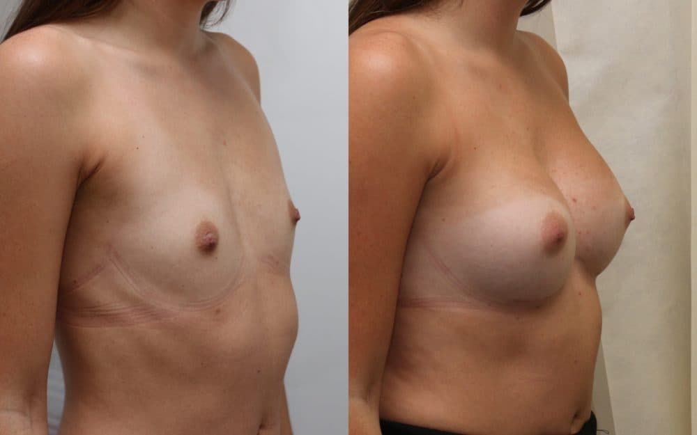 Small volume breast enlargement