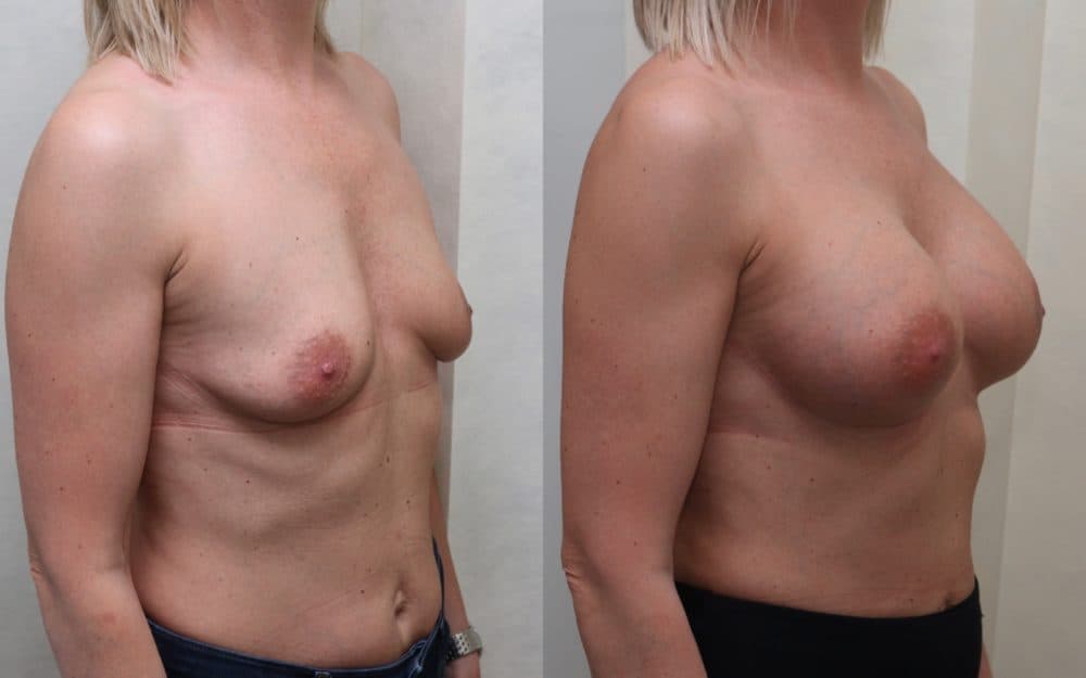 Dual plane breast implants