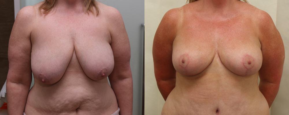 Breast lift/ reduction