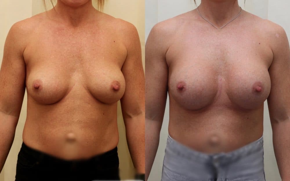 Exchange Of Breast Implants From 330cc To 460cc Full Profile Round Implants