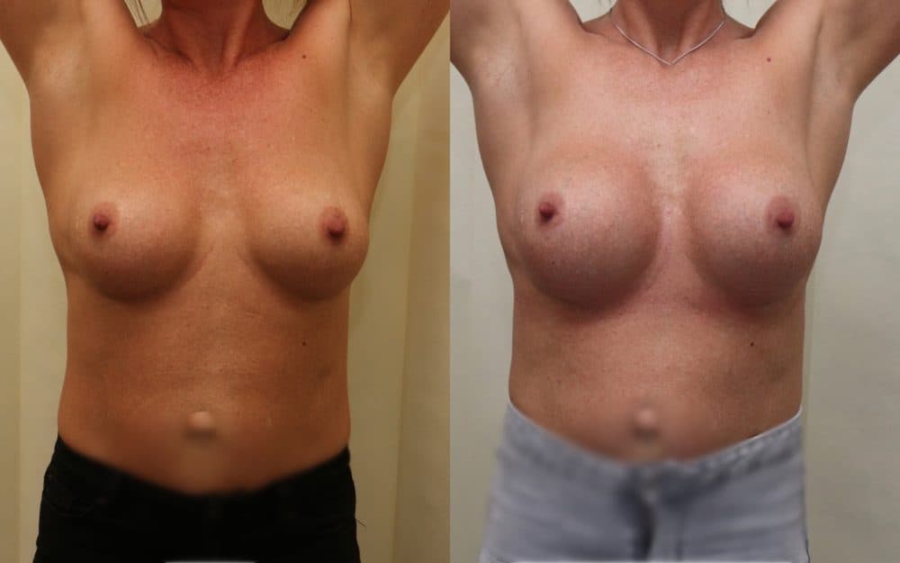Exchange Of Breast Implants From 330cc To 460cc Full Profile Round Implants
