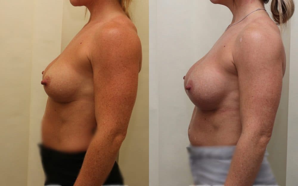 Exchange Of Breast Implants From 330cc To 460cc Full Profile Round Implants