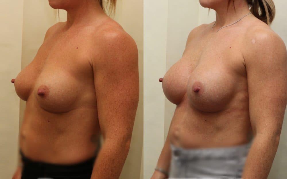 Exchange Of Breast Implants From 330cc To 460cc Full Profile Round Implants