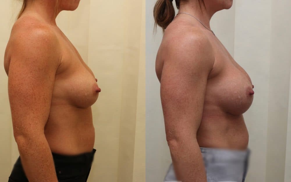 Exchange Of Breast Implants From 330cc To 460cc Full Profile Round Implants