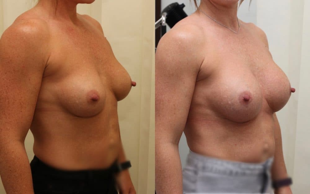 Exchange Of Breast Implants From 330cc To 460cc Full Profile Round Implants