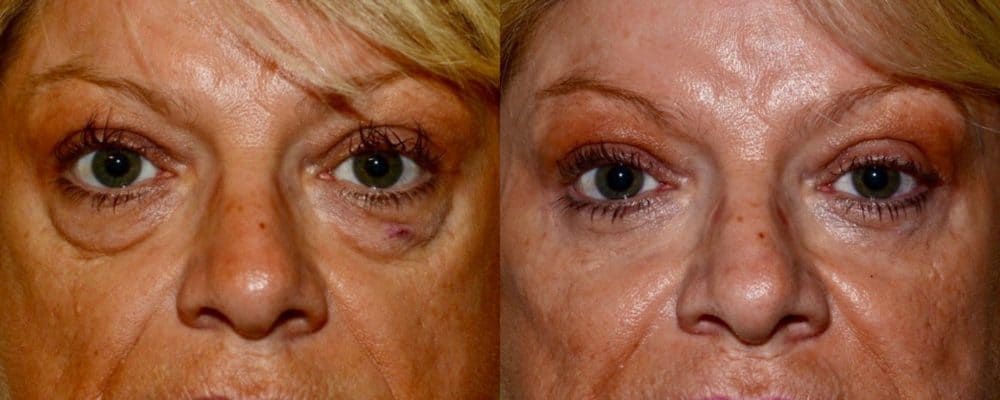 Lower eyelid surgery and fat transfer